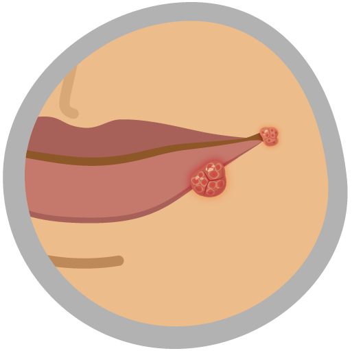 Sexsygdomme og prævention